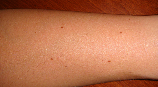 Numbers Of Moles On Arm Predicts Skin Cancer Risk Jasarat 