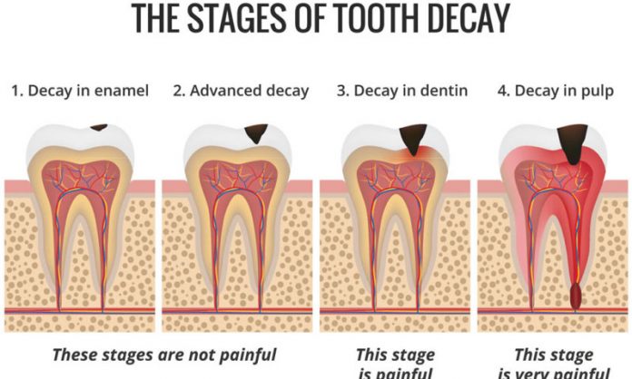 Not taking care of teeth can make you prone to cancer: research