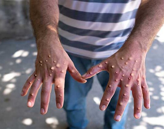 Three more suspected monkeypox cases reported in Karachi