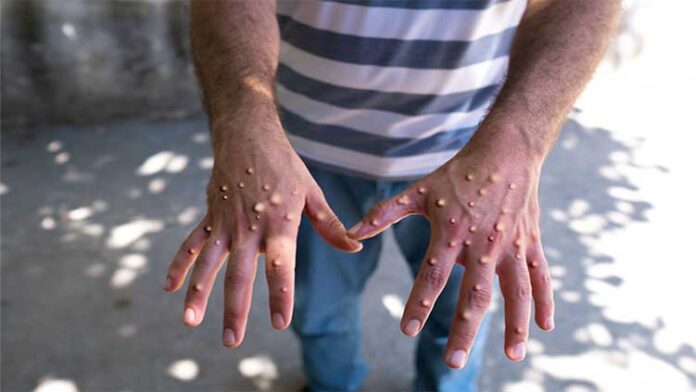 Three more suspected monkeypox cases reported in Karachi