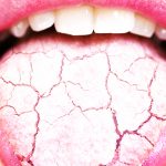 Xerostomia _ dry tongue